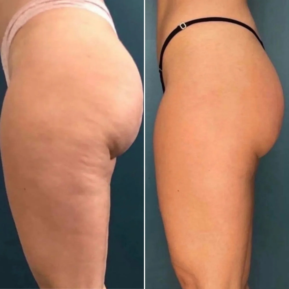 Dispositivo per il Trattamento della Cellulite